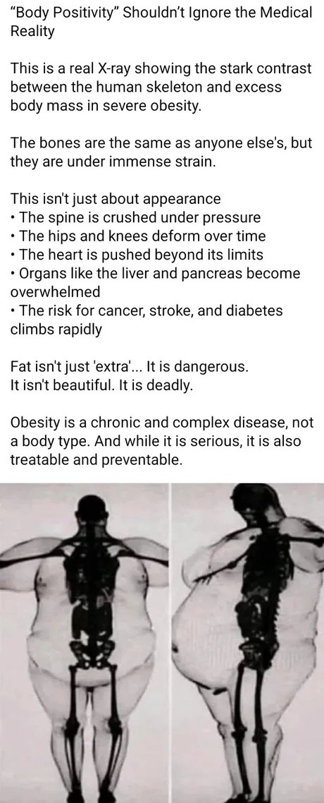 ﻿”Body Positivity” Shouldn’t Ignore the Medical Reality This is a real showing the stark contrast between the human skeleton and excess body mass in severe obesity: The bones are the same as anyone else’s, but are under immense strain. This isntt just about appearance The spine is crushed under pressure The hips and knees deform over time The heart is pushed beyond its limits Organs like the liver and pancreas become overwhelmed The risk for cancer; stroke, and diabetes climbs rapidly Fat isn’t just ‘extra’ It is dangerous_ It isn’t beautiful. It is deadly: Obesity is a chronic and complex disease, not body type_ And while it is serious,it is also treatable and preventable_ X-ray they