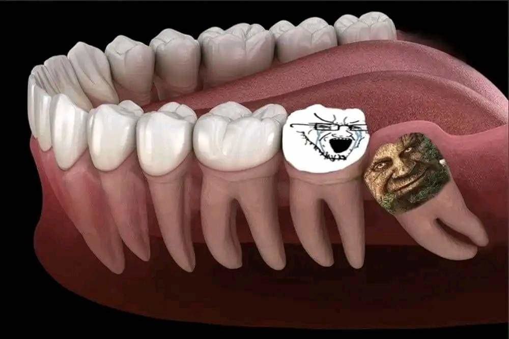 Wisdom tooth - meme