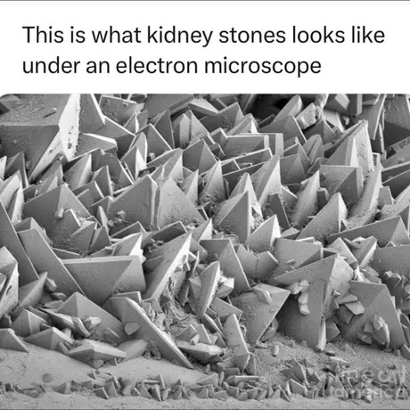 Kidney stones - meme