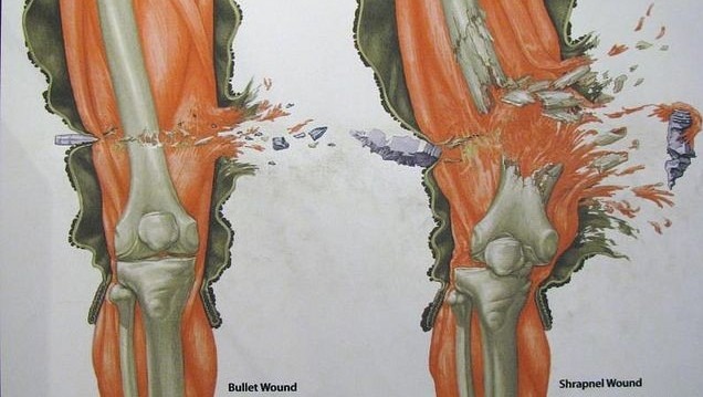 Shrapnel vs. Bullet wounds - meme